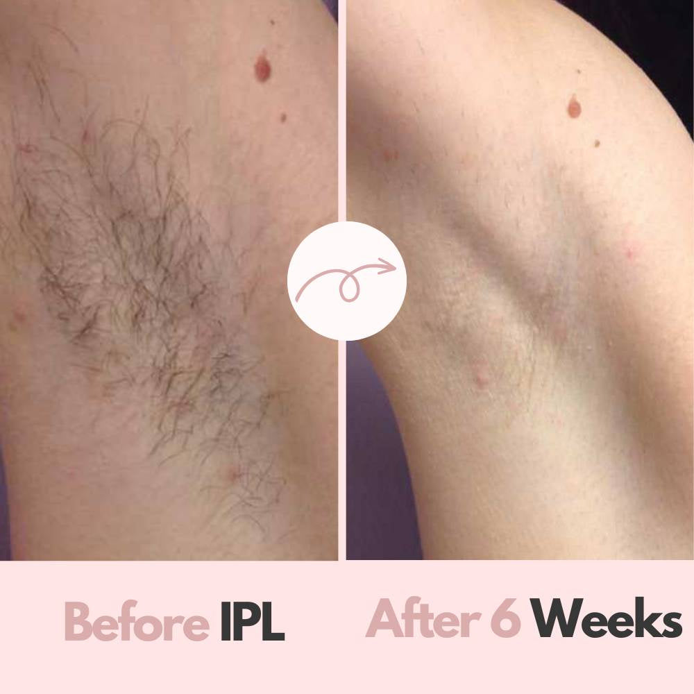 Glamour Pro™ IPL Hair removal device