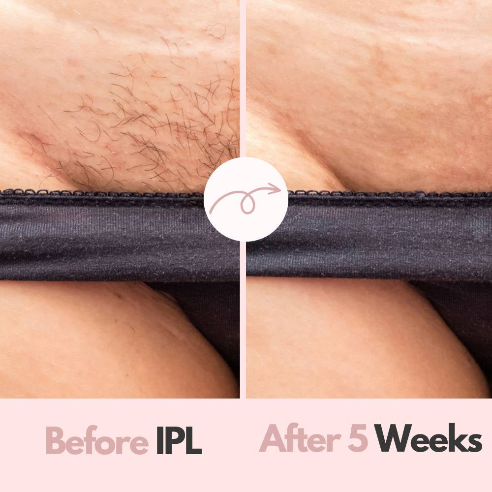 Glamour Pro™ IPL Hair removal device